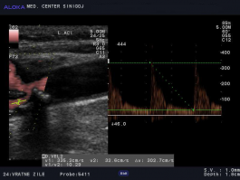 Ultrazvok vratnih žil - hemodinamsko pomembna zožitev notranje karotidne arterije
